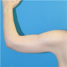 Arm Lift After Photo by Joshua Cooper, MD; Seattle, WA - Case 48376