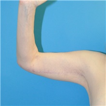Arm Lift After Photo by Joshua Cooper, MD; Seattle, WA - Case 48376