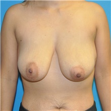 Breast Lift Before Photo by Joshua Cooper, MD; Seattle, WA - Case 48416