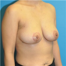Breast Lift After Photo by Joshua Cooper, MD; Seattle, WA - Case 48416