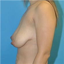 Breast Lift Before Photo by Joshua Cooper, MD; Seattle, WA - Case 48416