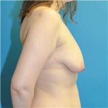 Breast Lift Before Photo by Joshua Cooper, MD; Seattle, WA - Case 48418