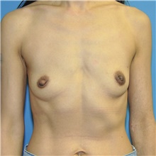 Breast Augmentation Before Photo by Joshua Cooper, MD; Seattle, WA - Case 48468