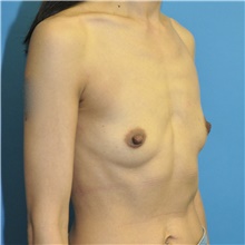 Breast Augmentation Before Photo by Joshua Cooper, MD; Seattle, WA - Case 48468