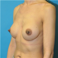 Breast Augmentation After Photo by Joshua Cooper, MD; Seattle, WA - Case 48468