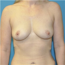 Breast Reduction After Photo by Joshua Cooper, MD; Seattle, WA - Case 48479