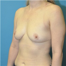Breast Reduction After Photo by Joshua Cooper, MD; Seattle, WA - Case 48479