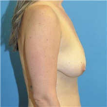 Breast Reduction Before Photo by Joshua Cooper, MD; Seattle, WA - Case 48479