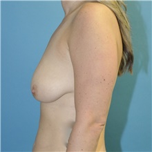 Breast Reduction Before Photo by Joshua Cooper, MD; Seattle, WA - Case 48479
