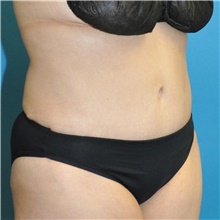 Tummy Tuck After Photo by Joshua Cooper, MD; Seattle, WA - Case 48481
