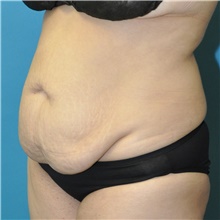Tummy Tuck Before Photo by Joshua Cooper, MD; Seattle, WA - Case 48481