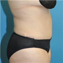 Tummy Tuck After Photo by Joshua Cooper, MD; Seattle, WA - Case 48481