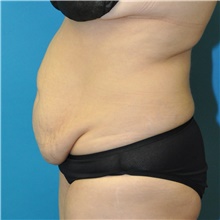 Tummy Tuck Before Photo by Joshua Cooper, MD; Seattle, WA - Case 48481