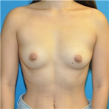 Breast Augmentation Before Photo by Joshua Cooper, MD; Seattle, WA - Case 49030