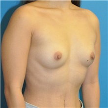 Breast Augmentation Before Photo by Joshua Cooper, MD; Seattle, WA - Case 49030