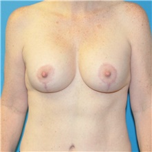 Breast Lift After Photo by Joshua Cooper, MD; Seattle, WA - Case 49032