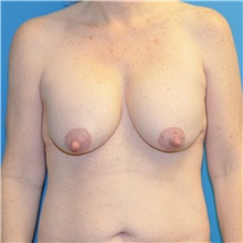 Breast Lift Before Photo by Joshua Cooper, MD; Seattle, WA - Case 49032