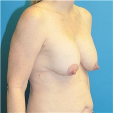 Breast Lift Before Photo by Joshua Cooper, MD; Seattle, WA - Case 49032