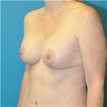 Breast Lift After Photo by Joshua Cooper, MD; Seattle, WA - Case 49032