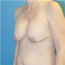 Breast Lift Before Photo by Joshua Cooper, MD; Seattle, WA - Case 49032