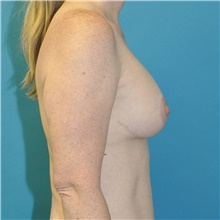 Breast Lift After Photo by Joshua Cooper, MD; Seattle, WA - Case 49032