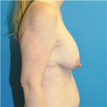 Breast Lift Before Photo by Joshua Cooper, MD; Seattle, WA - Case 49032