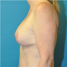 Breast Lift After Photo by Joshua Cooper, MD; Seattle, WA - Case 49032