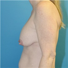 Breast Lift Before Photo by Joshua Cooper, MD; Seattle, WA - Case 49032