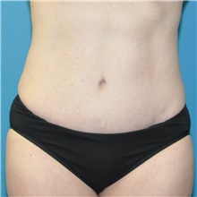 Tummy Tuck After Photo by Joshua Cooper, MD; Seattle, WA - Case 49033