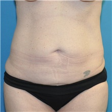 Tummy Tuck Before Photo by Joshua Cooper, MD; Seattle, WA - Case 49033