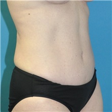 Tummy Tuck After Photo by Joshua Cooper, MD; Seattle, WA - Case 49033