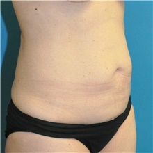 Tummy Tuck Before Photo by Joshua Cooper, MD; Seattle, WA - Case 49033