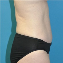 Tummy Tuck After Photo by Joshua Cooper, MD; Seattle, WA - Case 49033