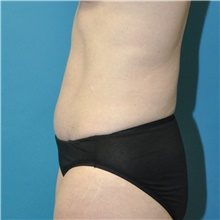 Tummy Tuck After Photo by Joshua Cooper, MD; Seattle, WA - Case 49033