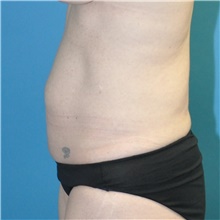 Tummy Tuck Before Photo by Joshua Cooper, MD; Seattle, WA - Case 49033