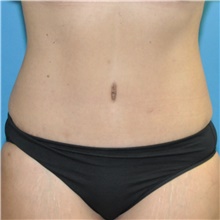 Tummy Tuck After Photo by Joshua Cooper, MD; Seattle, WA - Case 49041