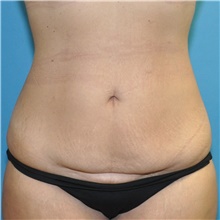 Tummy Tuck Before Photo by Joshua Cooper, MD; Seattle, WA - Case 49041