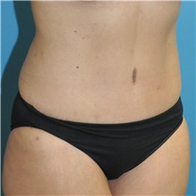 Tummy Tuck After Photo by Joshua Cooper, MD; Seattle, WA - Case 49041