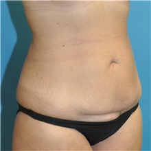 Tummy Tuck Before Photo by Joshua Cooper, MD; Seattle, WA - Case 49041