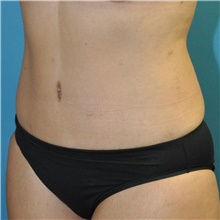 Tummy Tuck After Photo by Joshua Cooper, MD; Seattle, WA - Case 49041