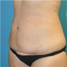 Tummy Tuck Before Photo by Joshua Cooper, MD; Seattle, WA - Case 49041