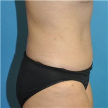 Tummy Tuck After Photo by Joshua Cooper, MD; Seattle, WA - Case 49041