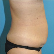 Tummy Tuck Before Photo by Joshua Cooper, MD; Seattle, WA - Case 49041