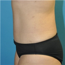 Tummy Tuck After Photo by Joshua Cooper, MD; Seattle, WA - Case 49041