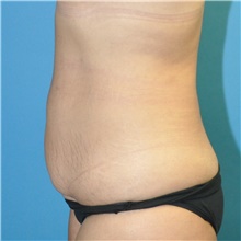 Tummy Tuck Before Photo by Joshua Cooper, MD; Seattle, WA - Case 49041