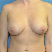 Breast Augmentation After Photo by Joshua Cooper, MD; Seattle, WA - Case 49224