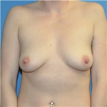 Breast Augmentation Before Photo by Joshua Cooper, MD; Seattle, WA - Case 49224