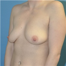 Breast Augmentation Before Photo by Joshua Cooper, MD; Seattle, WA - Case 49224