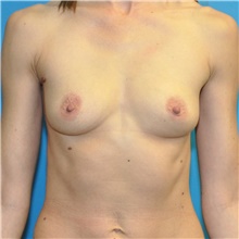 Breast Augmentation Before Photo by Joshua Cooper, MD; Seattle, WA - Case 49262