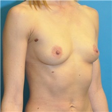 Breast Augmentation Before Photo by Joshua Cooper, MD; Seattle, WA - Case 49262